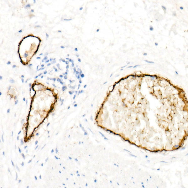 Immunohistochemistry of paraffin-embedded human esophageal cancer using von Willebrand factor (VWF) antibody at dilution of 1:800 (40x lens). Perform high pressure antigen retrieval with 10 mM citrate buffer pH 6. 0 before commencing with IHC staining protocol.