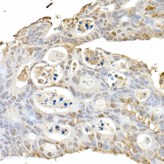 Immunohistochemistry of paraffin-embedded human colon carcinoma using HSP70 Rabbit pAb at dilution of 1:150 (40x lens). Perform high pressure antigen retrieval with 10 mM citrate buffer pH 6. 0 before commencing with IHC staining protocol.