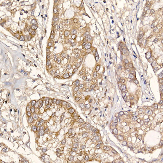Immunohistochemistry of paraffin-embedded human lung cancer using ERp19 Rabbit mAb at dilution of 1:200 (40x lens). Perform high pressure antigen retrieval with 10 mM citrate buffer pH 6. 0 before commencing with IHC staining protocol.