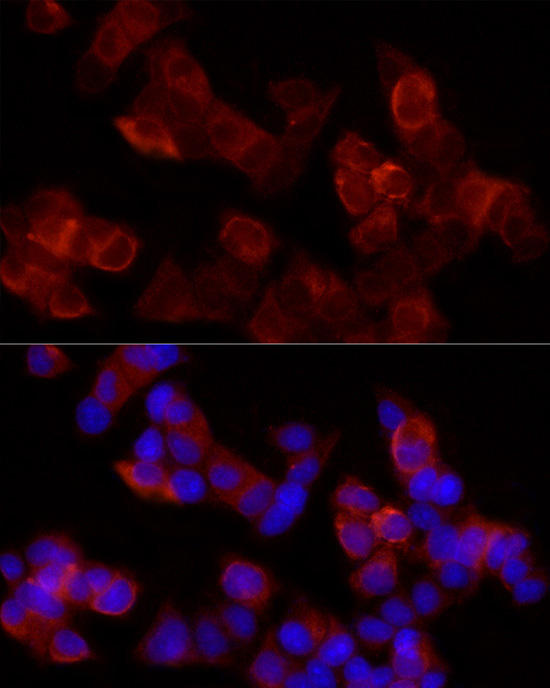 Immunohistochemistry of paraffin-embedded human stomach cancer using ALOX15 antibody at dilution of 1:200 (40x lens). Perform microwave antigen retrieval with 10 mM PBS buffer pH 7. 2 before commencing with IHC staining protocol.