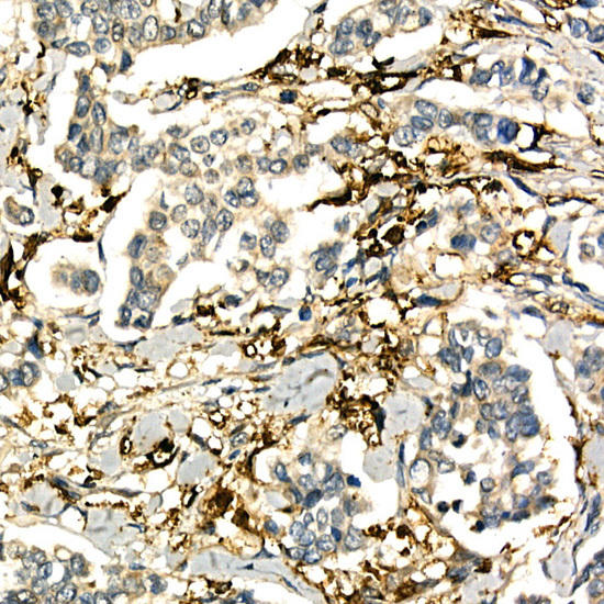 Immunohistochemistry of paraffin-embedded human breast cancer using LTA Rabbit pAb at dilution of 1:50 (40x lens). Perform high pressure antigen retrieval with 10 mM citrate buffer pH 6. 0 before commencing with IHC staining protocol.