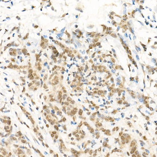 Immunohistochemistry of paraffin-embedded human breast cancer using RGS2 Rabbit pAb at dilution of 1:100 (40x lens). Perform high pressure antigen retrieval with 10 mM citrate buffer pH 6. 0 before commencing with IHC staining protocol.