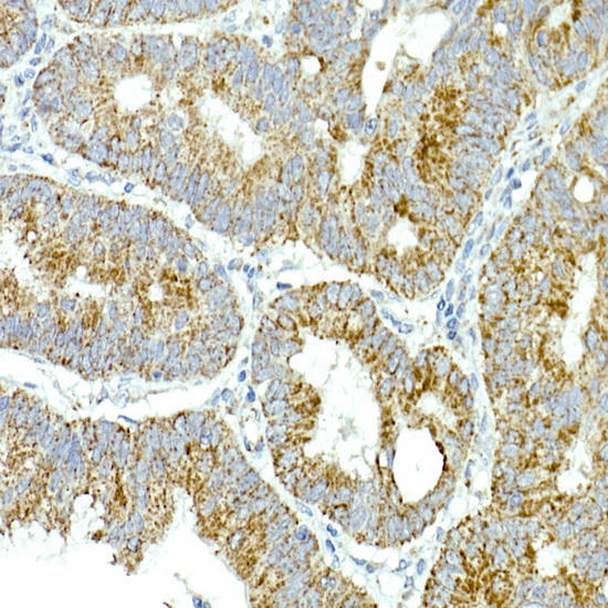 Immunohistochemistry of paraffin-embedded human colon carcinoma using MRPS15 Rabbit mAb at dilution of 1:250 (40x lens). Perform high pressure antigen retrieval with 10 mM citrate buffer pH 6. 0 before commencing with IHC staining protocol.