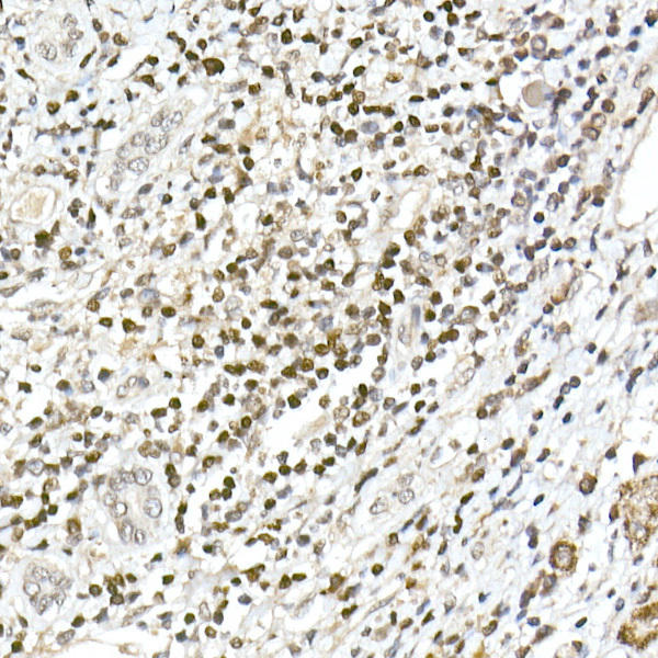 Immunohistochemistry of paraffin-embedded human liver cancer using TCF1/TCF7 Rabbit mAb at dilution of 1:100 (40x lens). Perform high pressure antigen retrieval with 10 mM citrate buffer pH 6. 0 before commencing with IHC staining protocol.