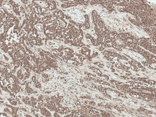 Immunohistochemistry analysis using Rabbit Anti-SFRP2 Polyclonal Antibody (STPA00085). Tissue: Liver. Species: Human. Fixation: Formalin Fixed Paraffin-Embedded. Primary Antibody: Rabbit Anti-SFRP2 Polyclonal Antibody (STPA00085) at 1:50 for 30 min at RT. Counterstain: Hematoxylin. Magnification: 20X. HRP-DAB Detection.