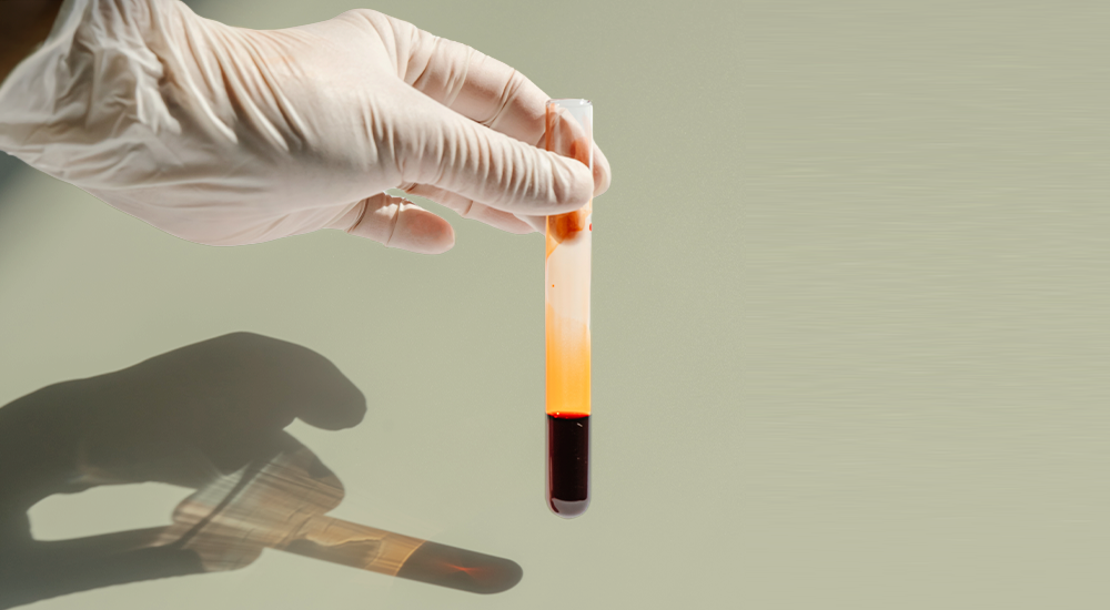 imagen Medición de colesterol total