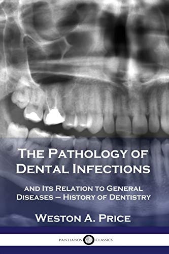 The Pathology of Dental  - Infections: and Its  - Relation to General  - Diseases  -  History of  - Dentistry