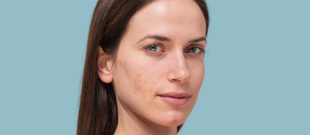 Adult Acne: A Guide to Supporting a Healthy Skin Barrier