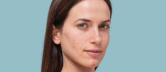 Adult Acne: A Guide to Supporting a Healthy Skin Barrier