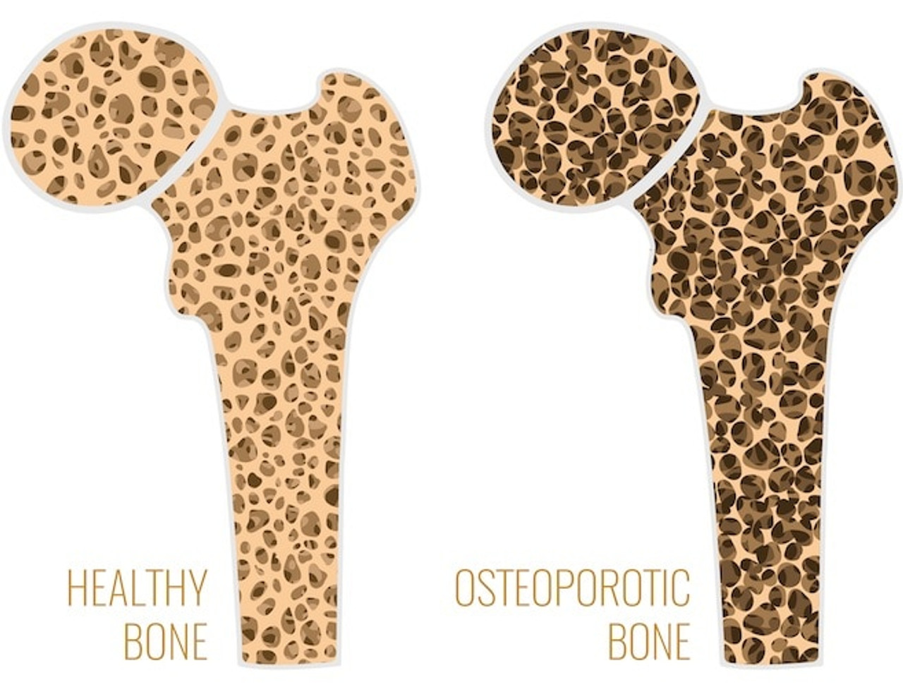 Osteo Mate® - Menaq7® Healthy bone vs OsteoPorotic Bone