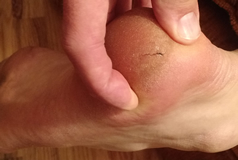 Cracked Heel Testimonial - Tallow Balm