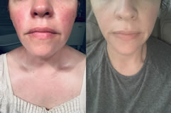 Tallow Balm for Scars Testimonials