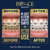 Teeth Whitening for Braces