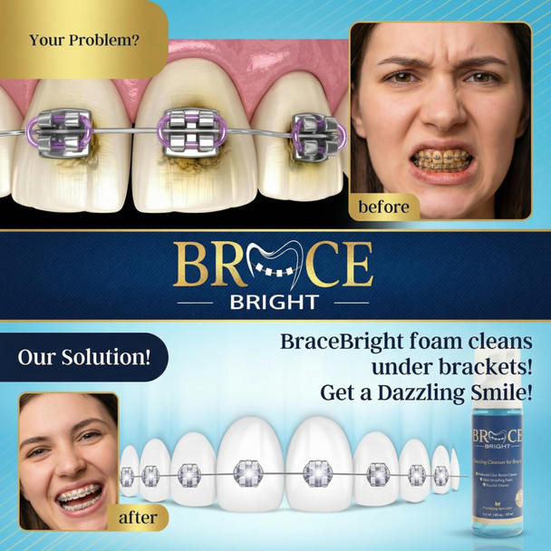 Teeth Whitening for Braces