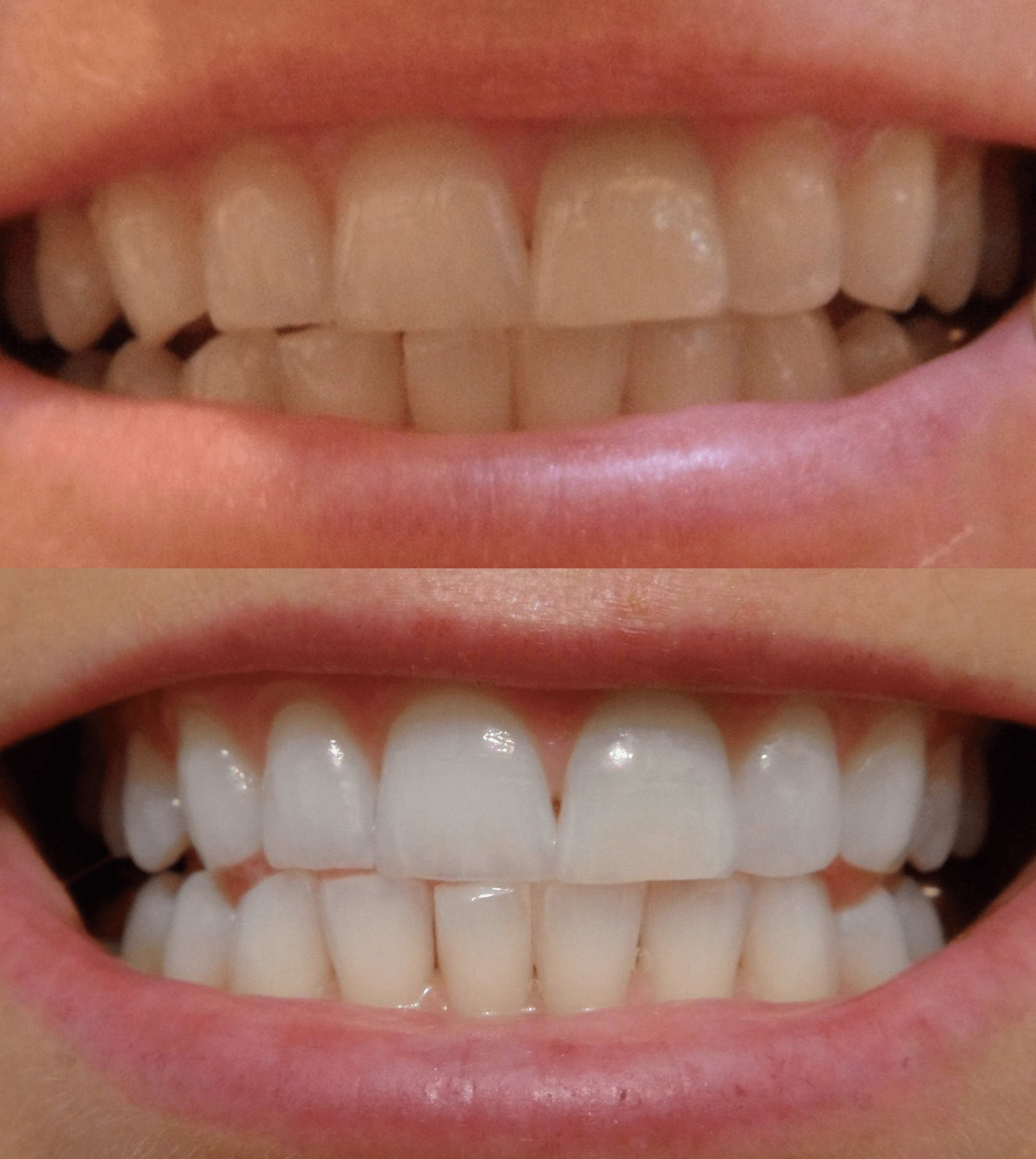 before and after teeth whitening results using the ibright smartphone whitening system
