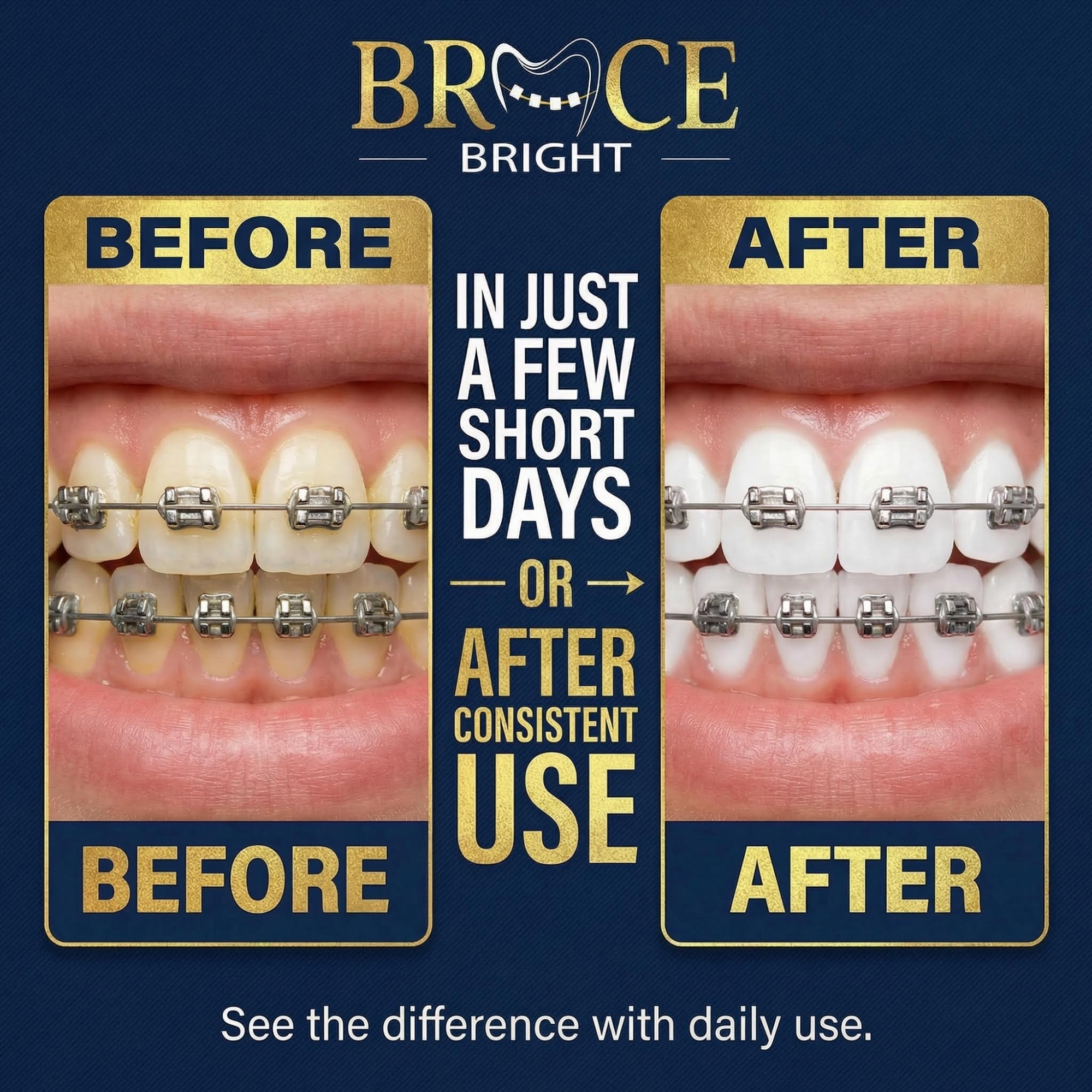 BraceBright before and after whitening teeth with braces