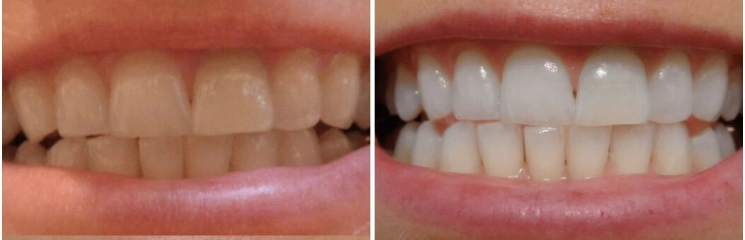 Teeth before and after BleachBright whitening treatment