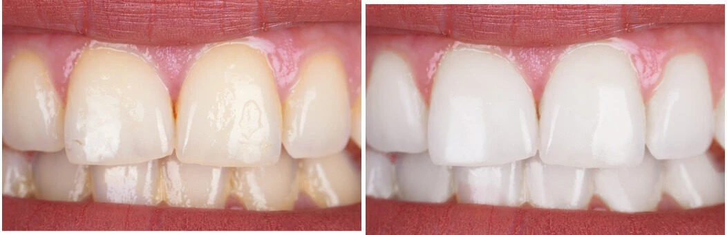 Close up of teeth before and after BleachBright whitening