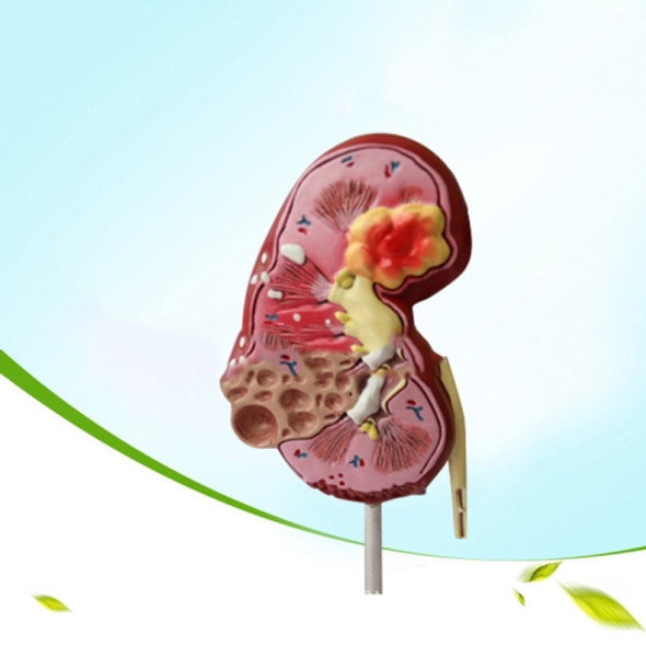 Nephropathy Model Kidney Pathology Nephrolithiasis Urology Communication Model Teaching Supplies