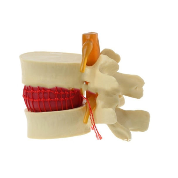 Human Lumbar Disc Herniation Demonstration Model Orthopedic Spine Model(Yellow)