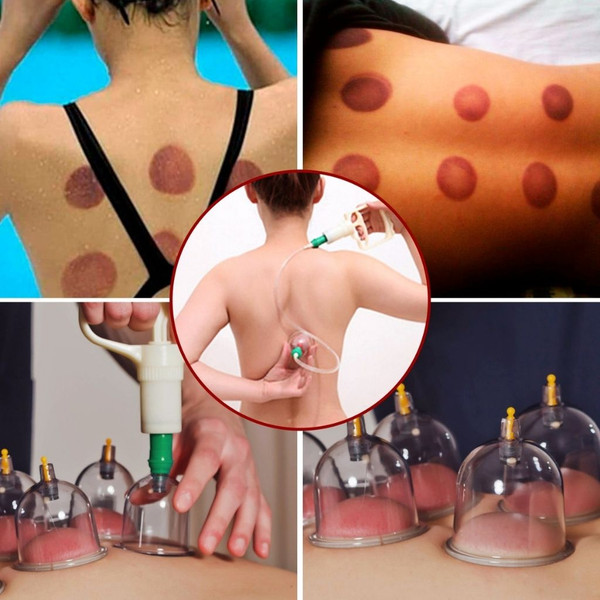 iNova™ 32-Cup Alternative Medicine Cupping Therapy Set product image