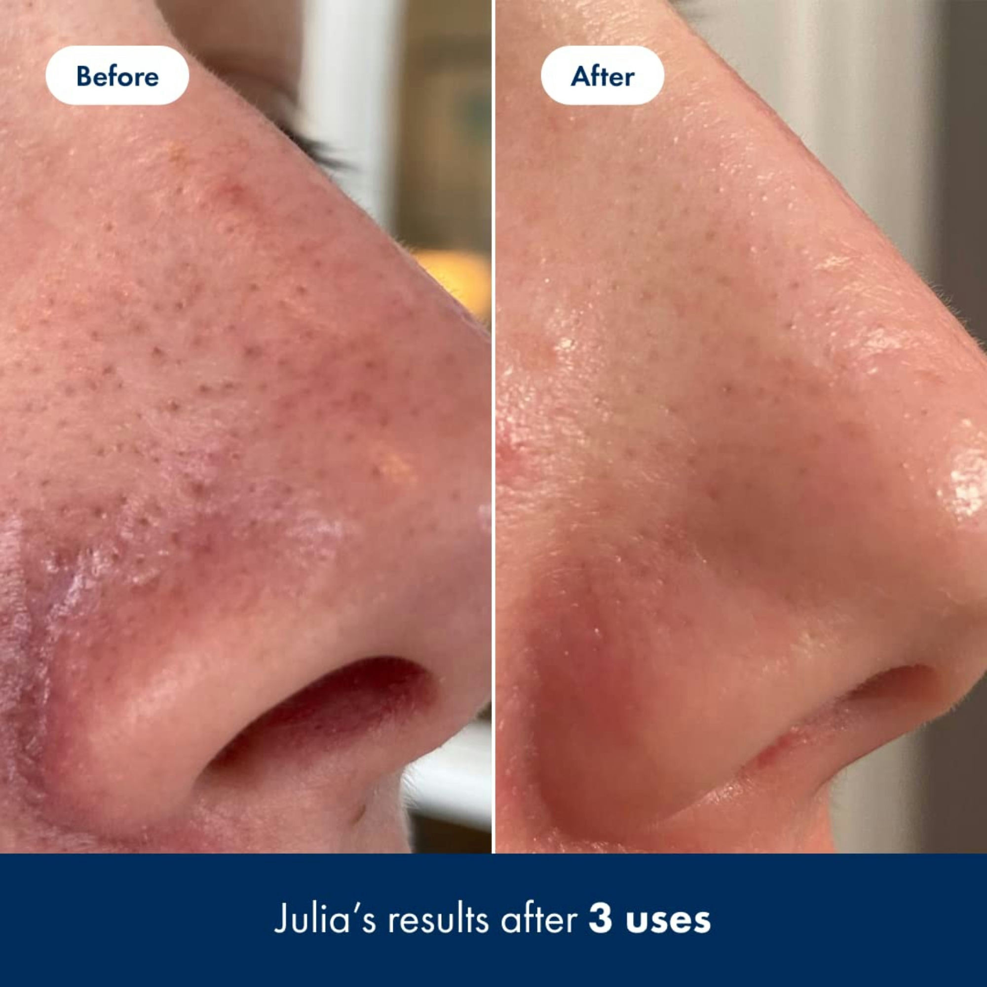 Hero Cosmetics Pore Release Blackhead Clearing Solution