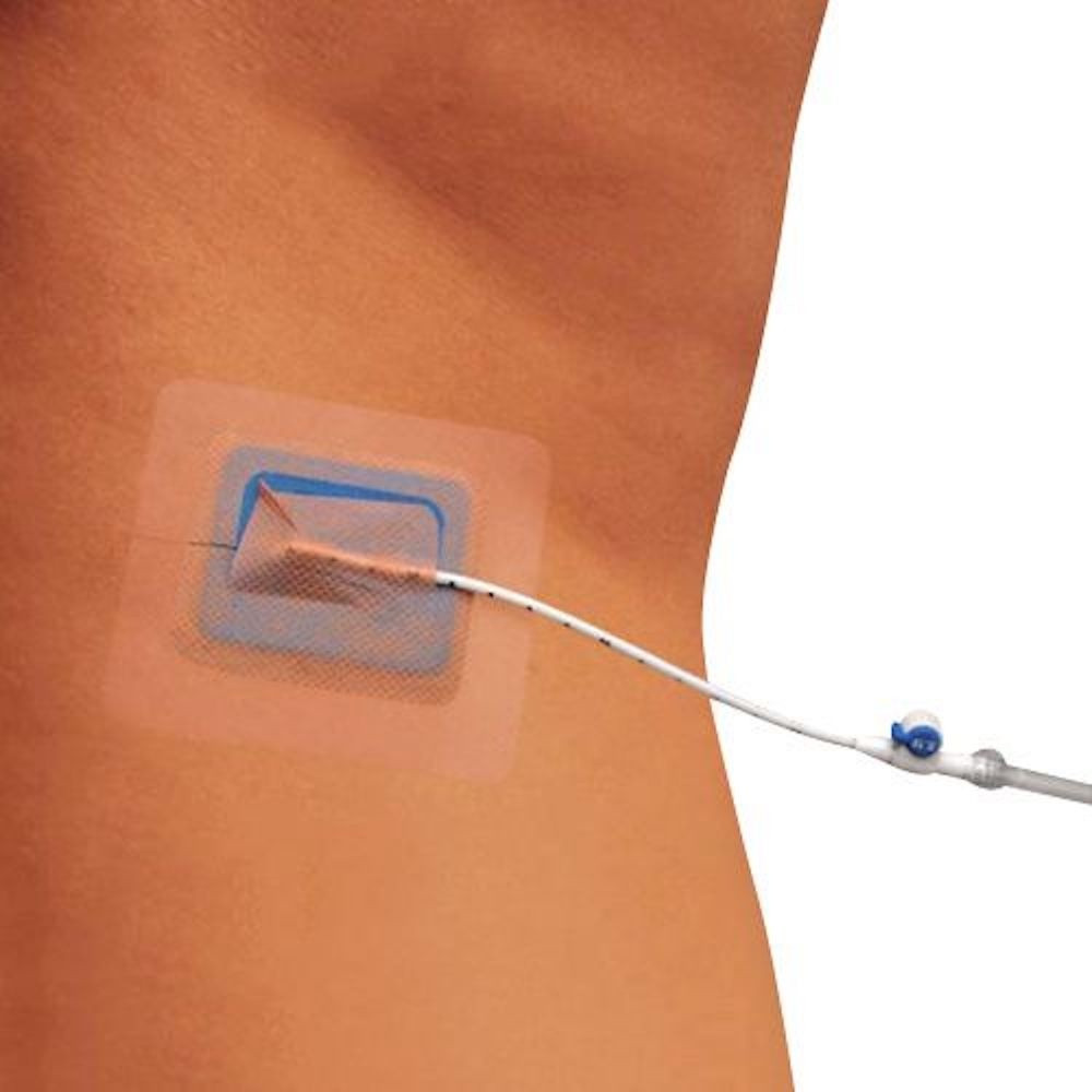 Stayfix Catheter Fixation Device