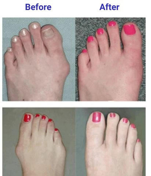 Bunion Corrector zaxx