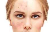 ​How to get rid of acne scars fast? These six tips will fade them away in no time