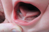 Ankyloglossia (Tongue Tie) and Oral Development