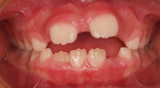 Occlusion vs Malocclusion – How Myo Munchee Supports Alignment