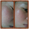 DermRoller - 540 Needle micro needle therapy system