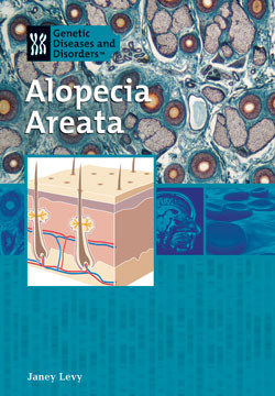 Alopecia Areata by Janey Levy, 9781404206939