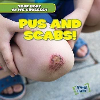 Pus and Scabs! by Melvin Hightower, 9781482464696