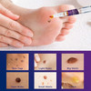 NOVOME Skin Tag Remover & Wart Remover - Quickly and Easily Remove Common Skin Tag, Wart and Callus - Effective and Scar-Free (4packs)