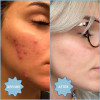 BLUME Meltdown Acne Oil