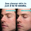 Vitamedica Clear Skin Vitamin Formula  Acne Supplement For Skin Clearing  Breakout Treatment For Women And Men  Vitamins A, C, E, Selenium, Chromium, And Zinc For Acne And Skin Health  60 Count