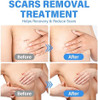 Silicone Scar Sheets, 4 Pair Scar Removal Tape, Reusable Medical Grade Silicone Scar Sheets For Breast