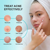 Acne Pimple Spot Treatment Cream: Cystic Hormonal Blackheads Blemish Remover For Face Back And Body - With 10% Azelaic Acid - Teens 13-19 & Young Adult 20-30 1.4 Oz