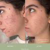 KAT BURKI VitaBiome Active Skin Optimizer With Vitamin C. Advanced Clearing and Redness Relief Face Mist for Breakout-Prone Skin