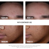 Neutrogena Stubborn Blackheads Daily Acne Facial Serum With Salicylic Glycolic Polyhydroxy & Mandelic Acids Oil-Free Face Serum For Acne-Prone Skin To Help Clear Clogged Pores 1 Fl. Oz