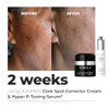 Dominas Dark Spot Correcting Duo - 10% Txa (Tranexamic Acid) Hyper P-Toning Serum & Dark Spot Corrector Cream Duo For Hyperpigmentation & Sun Spots