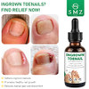 Smzhealing Ingrown Toenail Treatment: Ingrown Toenail Removal Kit - Ingrown Toenail Tool For Men Women - Ingrown Toenail Corrector Drops - Ingrown Toenail Remover - Effective Solution For Ingrown Toenails 30Ml