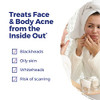Boiron Acne Relief Kit For Blackheads Oily Skins Whiteheads On The Face And Body - 3 Count (240 Pellets)