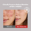 Mizon Goodbye Blemish Fresh Toner Bha Niacinamide For Excessive Sebum Troubled Skin Acne Treat Breakout Treat Korean Skincare Acne Spot Treat Smooth Skin (120Ml/4.05 Fl. Oz.)
