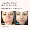 Mdacne Acne Treatment Benzoyl Peroxide Cream 5% Unclogs Pores Reduces Blemishes and