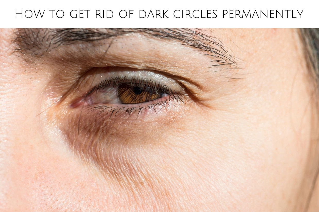 How to Get Rid of Dark Circles Permanently