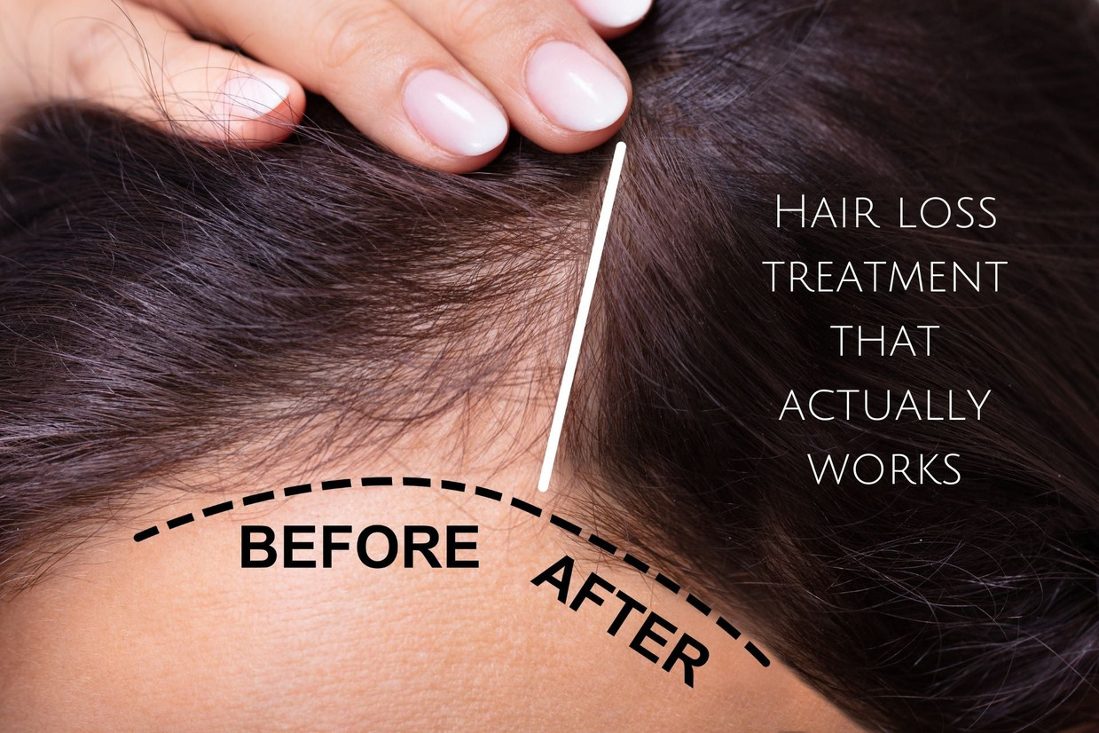 Hair loss treatment that actually works