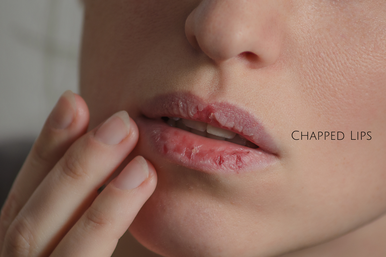 How to Relieve Chapped Lips