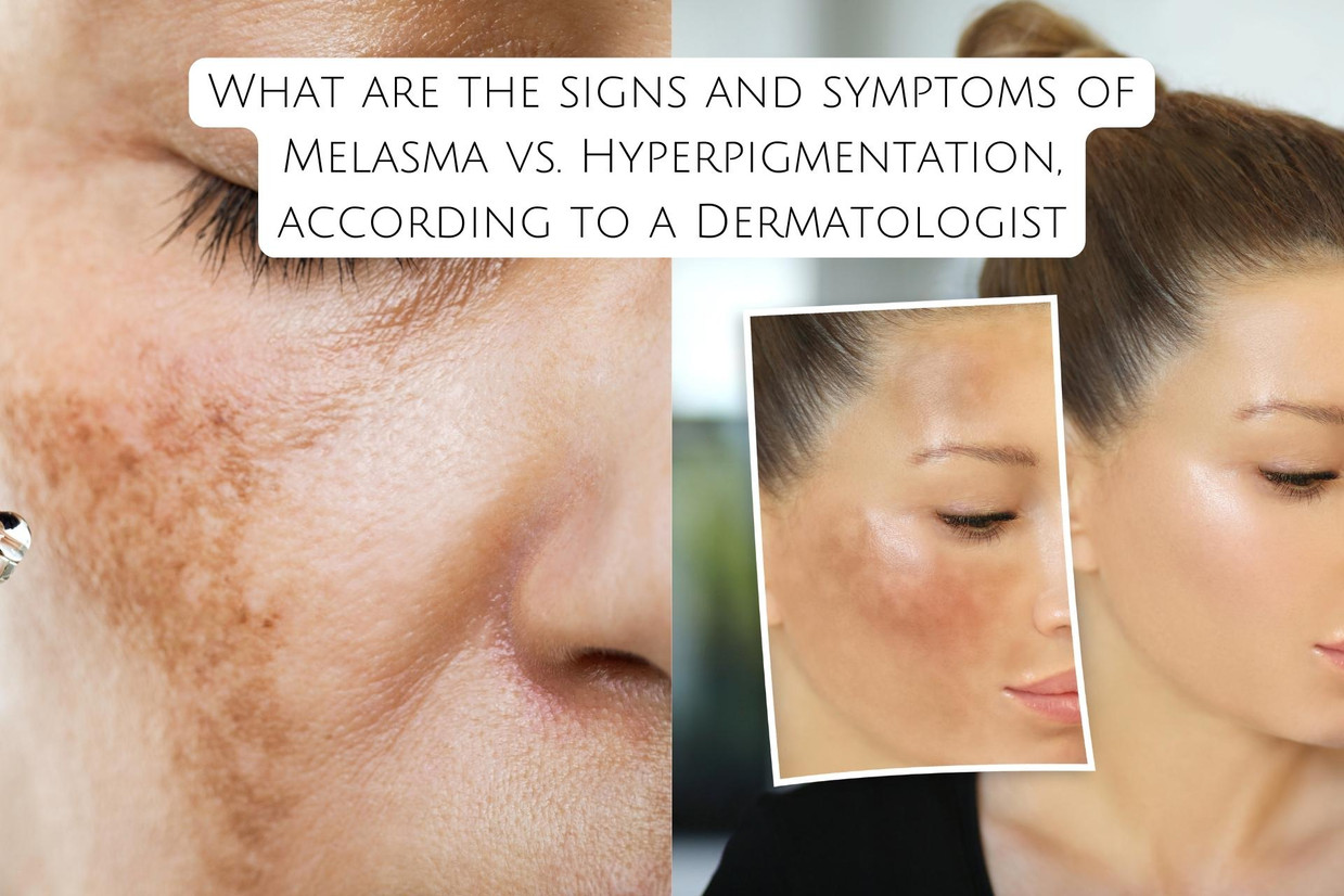 What are the signs and symptoms of Melasma vs. Hyperpigmentation, according to a Dermatologist What are the signs and symptoms of Melasma vs. Hyperpigmentation, according to a Dermatologist